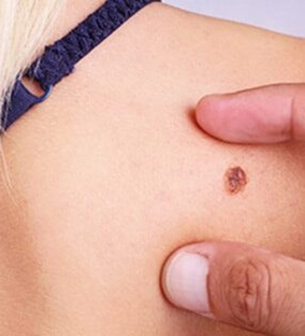 melanom-cilt-kanseri-1-463x312